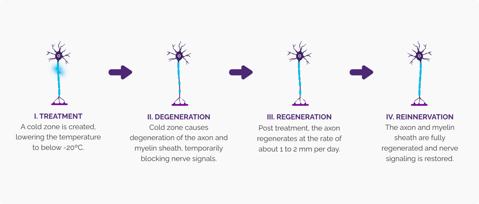 Diagram of nerve stages when using iovera: cold therapy, degeneration, regeneration and restored signaling.